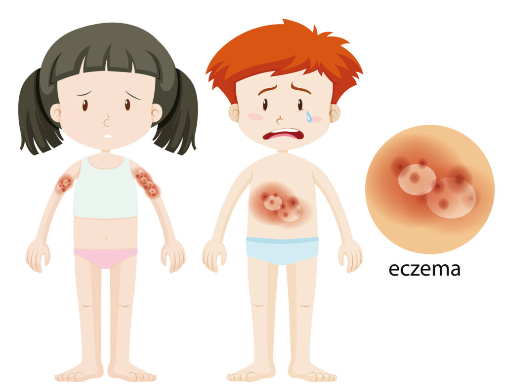 dermatita atopica la copii